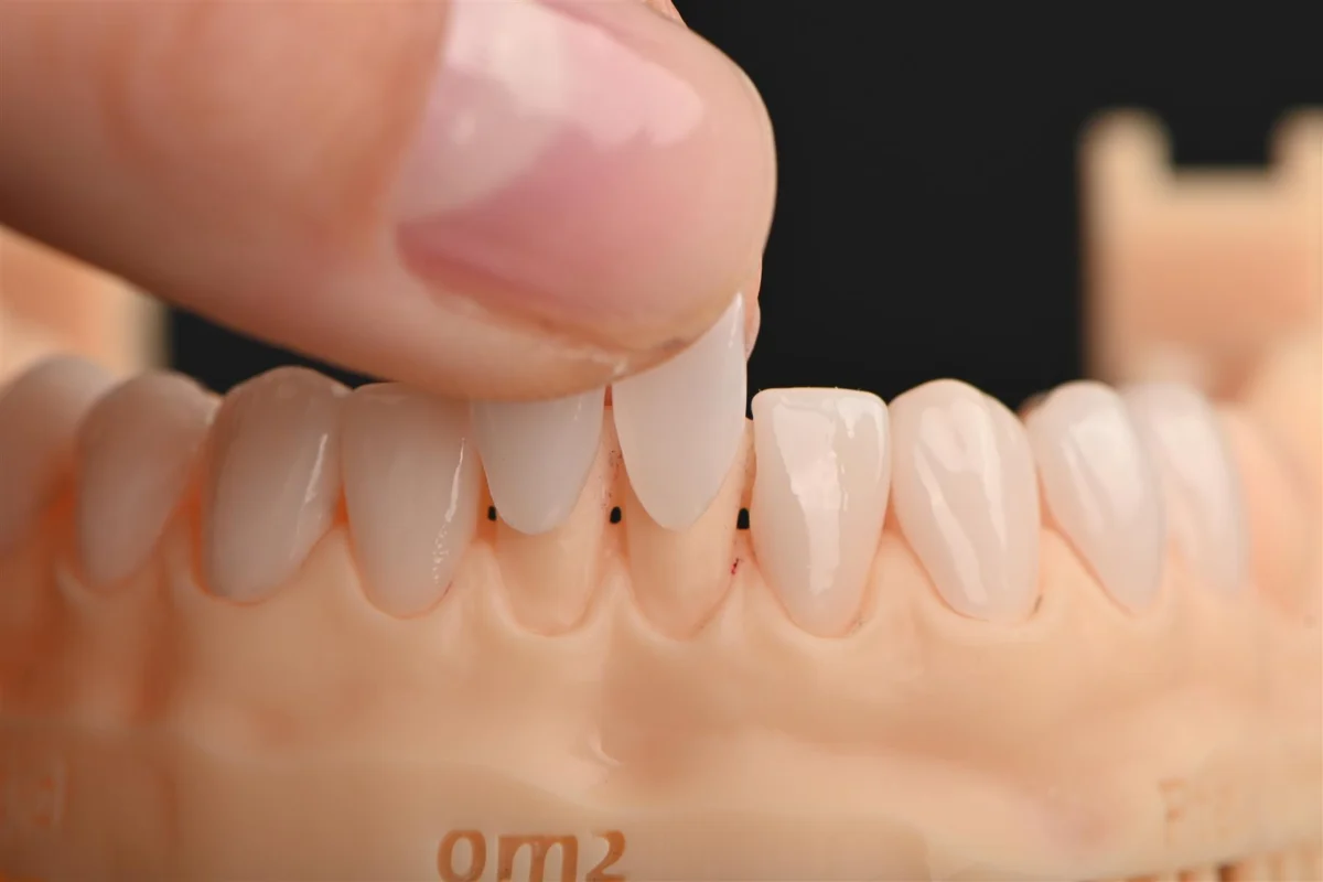 Carillas dentales sobre un modelo