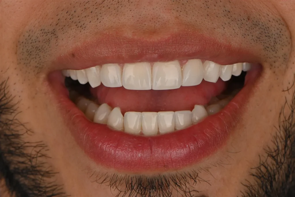 Paciente sonriendo después de su diseño de sonrisa