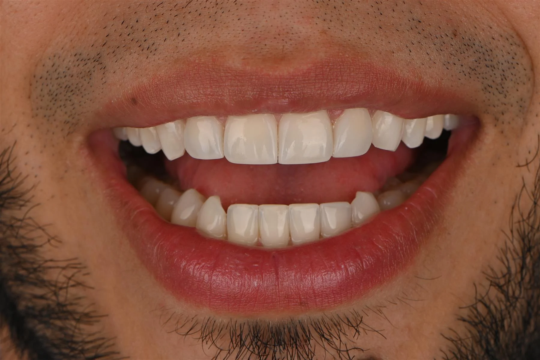 Paciente sonriendo después de su diseño de sonrisa