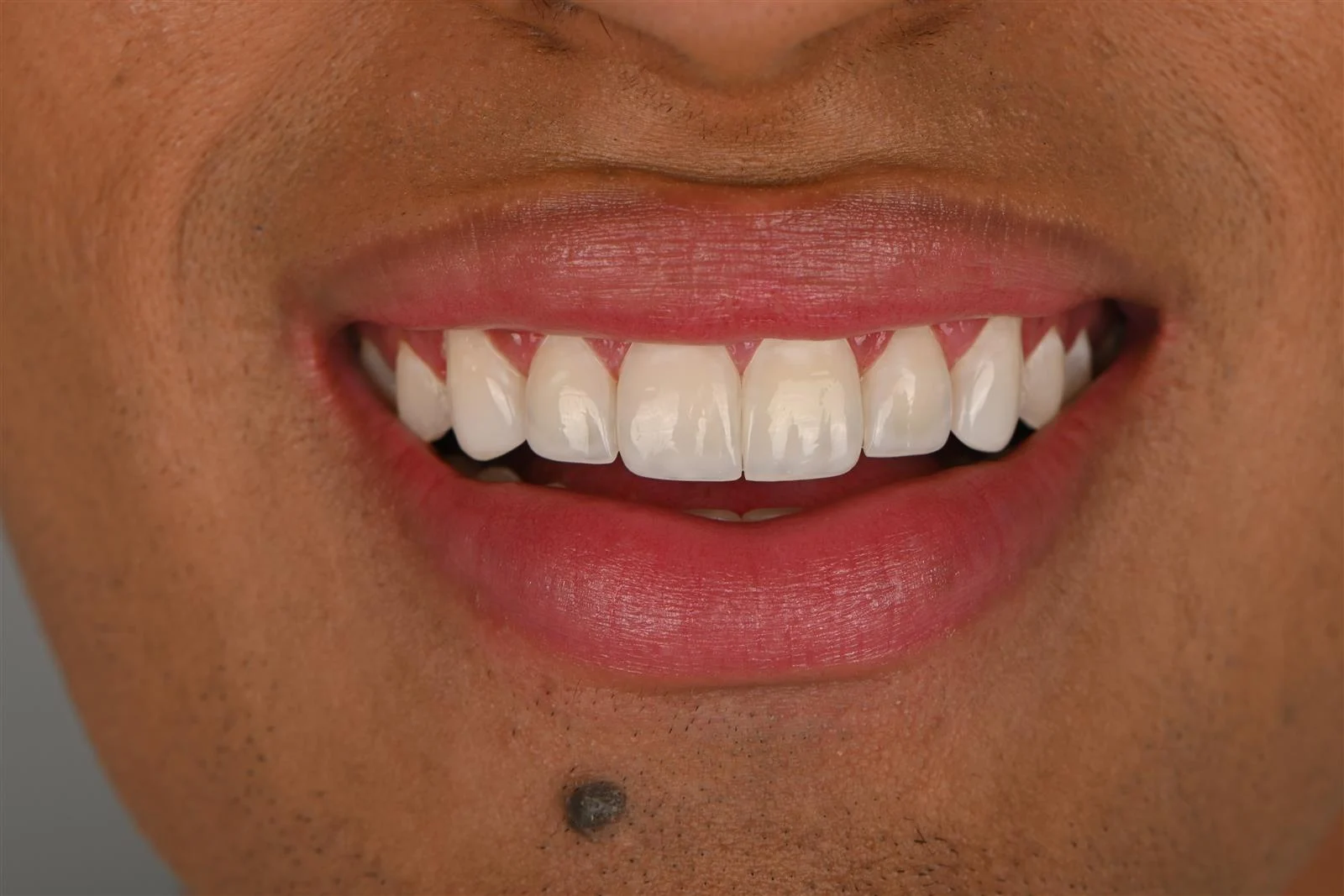 Sonrisa con implantes dentales