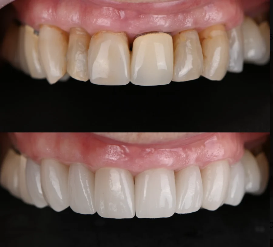 Antes y después: dientes manchados