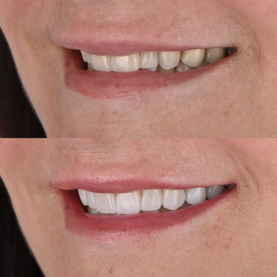 Antes y después: dientes pequeños