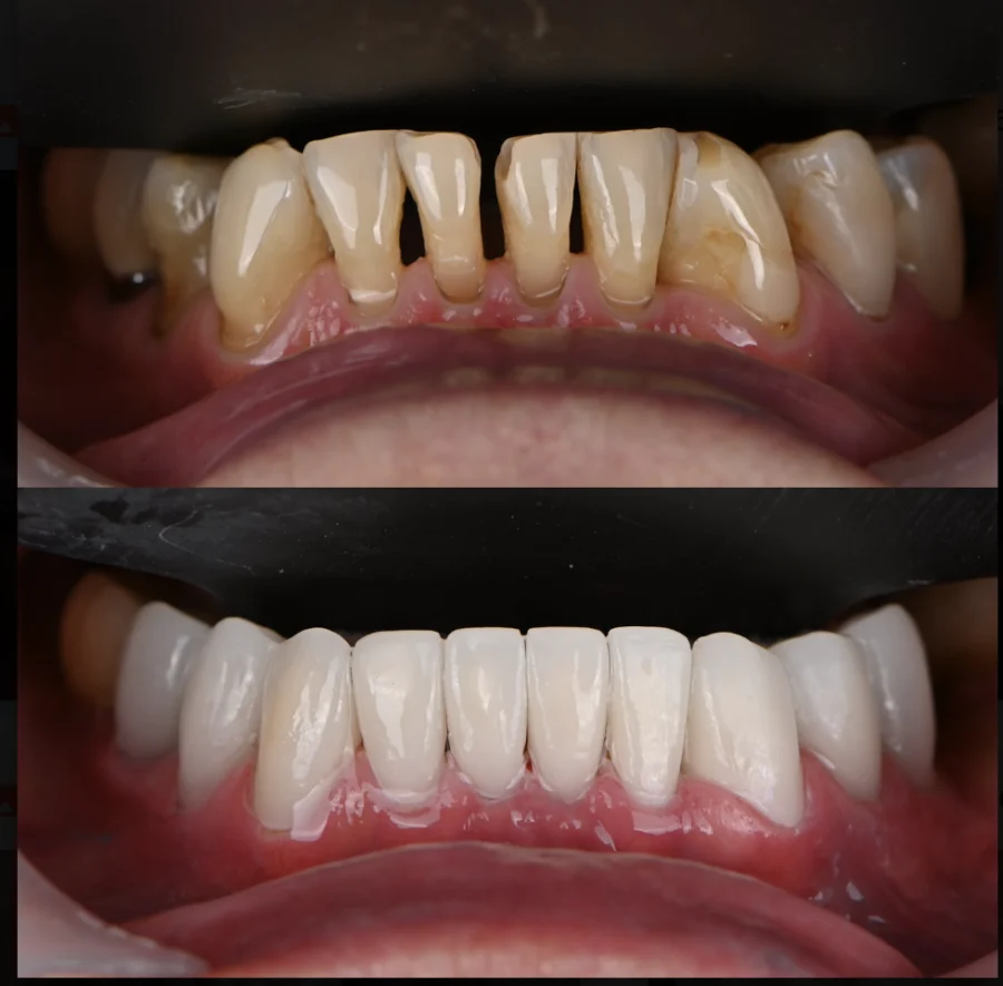 Antes y después: espacios entre dientes
