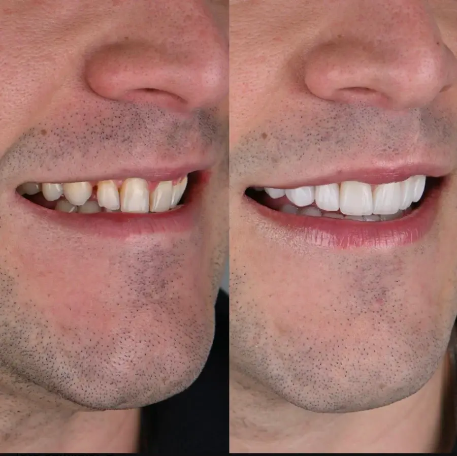 Antes y después: sonrisa renovada
