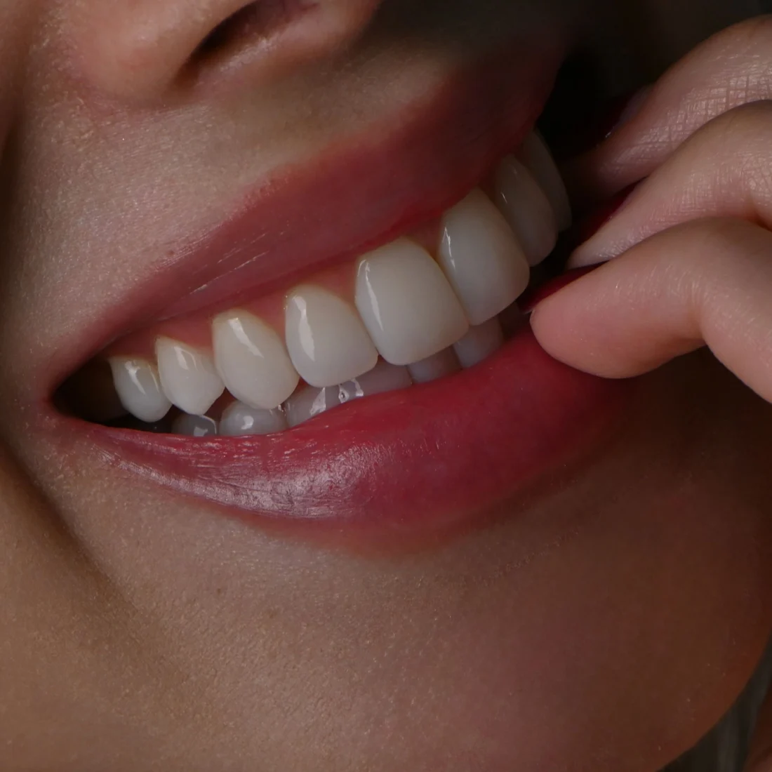 Sonrisa con carillas cementadas
