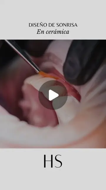 Video: diseño de sonrisa en cerámica
