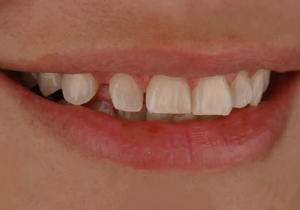 Sonrisa de Aimara antes del tratamiento
