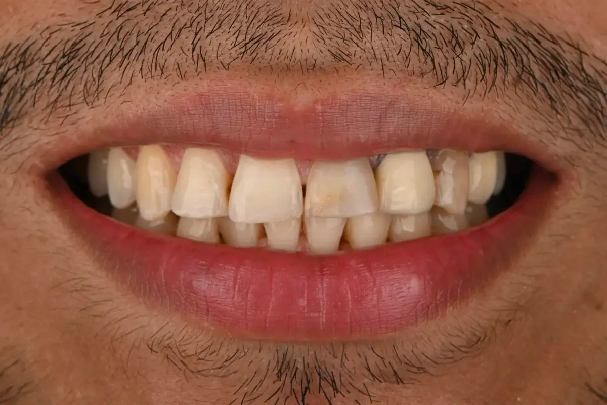 Sonrisa de Juan David antes del tratamiento