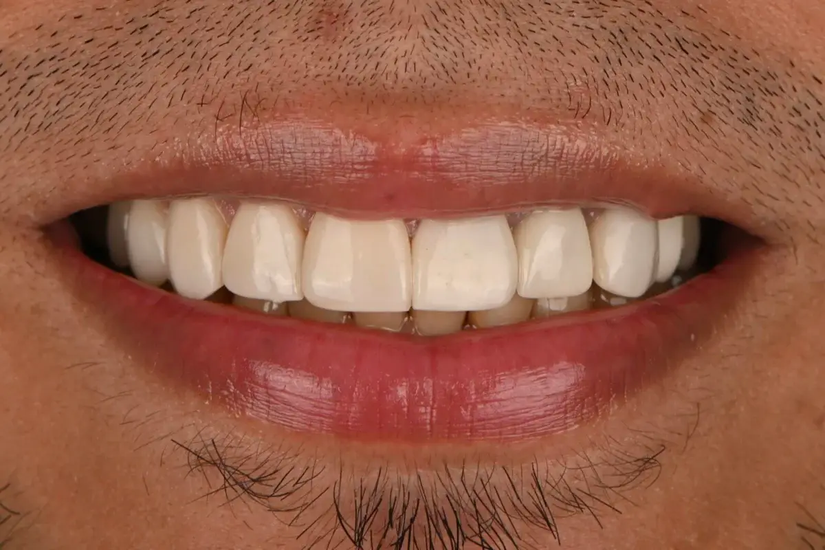 Sonrisa de Juan David después del tratamiento