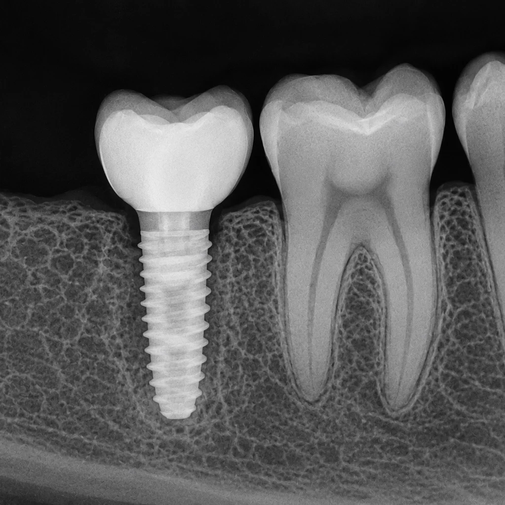 Radiografía de implantes dentales en Medellín